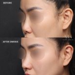Before and after revision rhinoplasty results at VG Plastic Surgery, improved nose shape