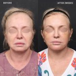 Facelift before and after results at VG Plastic Surgery, visible facial rejuvenation after 2 weeks