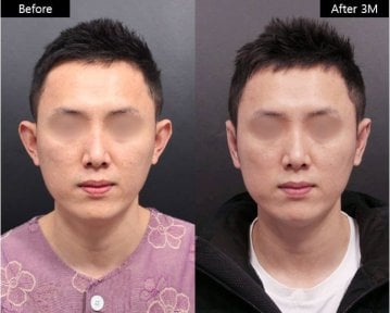 Resultados de rinoplastia antes y después en VG Plastic Surgery, mejor forma nasal tras 3 meses