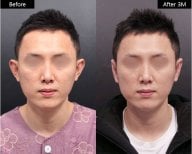 Resultados de rinoplastia antes y después en VG Plastic Surgery, mejor forma nasal tras 3 meses