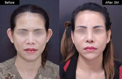Resultados de otoplastia antes y después en VG Plastic Surgery, corrección de orejas natural