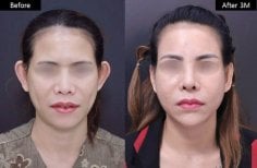 Resultados de otoplastia antes y después en VG Plastic Surgery, corrección de orejas natural