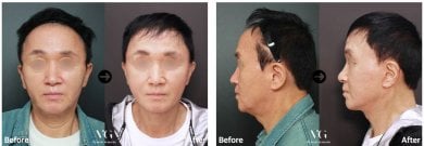 Before and after deep plane facelift results at VG Plastic Surgery, visible facial rejuvenation