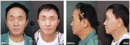 Before and after deep plane facelift results at VG Plastic Surgery, visible facial rejuvenation