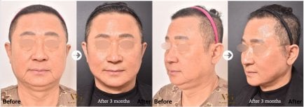 Before and after deep plane facelift results at VG Plastic Surgery, visible facial rejuvenation