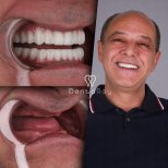 Resultado antes y después de implantes dentales All-on-6 en Dentaray Clinic, sonrisa completa