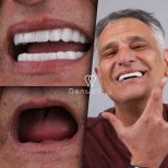 Resultados antes y después de implantes dentales All-on-6 en Dentaray Clinic, sonrisa restaurada