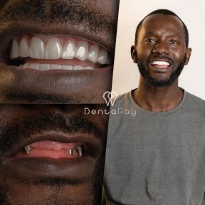 Resultados antes y después de implantes dentales All-on-6 en Dentaray Clinic, sonrisa restaurada