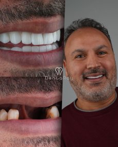 Resultados antes y después de implantes dentales All-on-6 en Dentaray Clinic, sonrisa restaurada