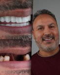 Resultados antes y después de implantes dentales All-on-6 en Dentaray Clinic, sonrisa restaurada