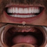 Resultados de implantes dentales All-on-6 antes y después en Dentaray Clinic, sonrisa completa
