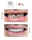 Before and after All-on-6 dental implants result at TH Dental Clinic, improved smile aesthetics