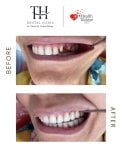 Before and after All-on-6 dental implants result at TH Dental Clinic – restored full smile