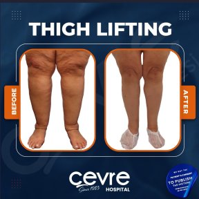 Resultados de lifting de muslos antes y después en Adem and Havva Medical Center, mejor contorno