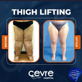 Resultados de lifting de muslos antes y después en Adem and Havva Medical Center, mejor contorno