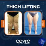 Resultados de lifting de muslos antes y después en Adem and Havva Medical Center, mejor contorno