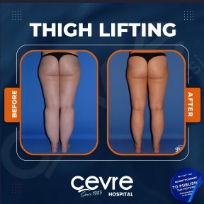 Resultados antes y después de lifting de muslos en Adem and Havva Medical Center, mejor contorno