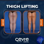 Resultados antes y después de lifting de muslos en Adem and Havva Medical Center, mejor contorno