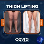 Resultados antes y después de lifting de muslos en Adem and Havva Medical Center, mejor contorno