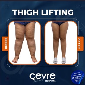 Resultados de lifting de muslos antes y después en Adem and Havva Medical Center, mejor contorno