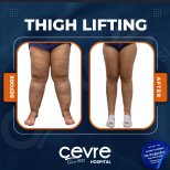 Resultados de lifting de muslos antes y después en Adem and Havva Medical Center, mejor contorno