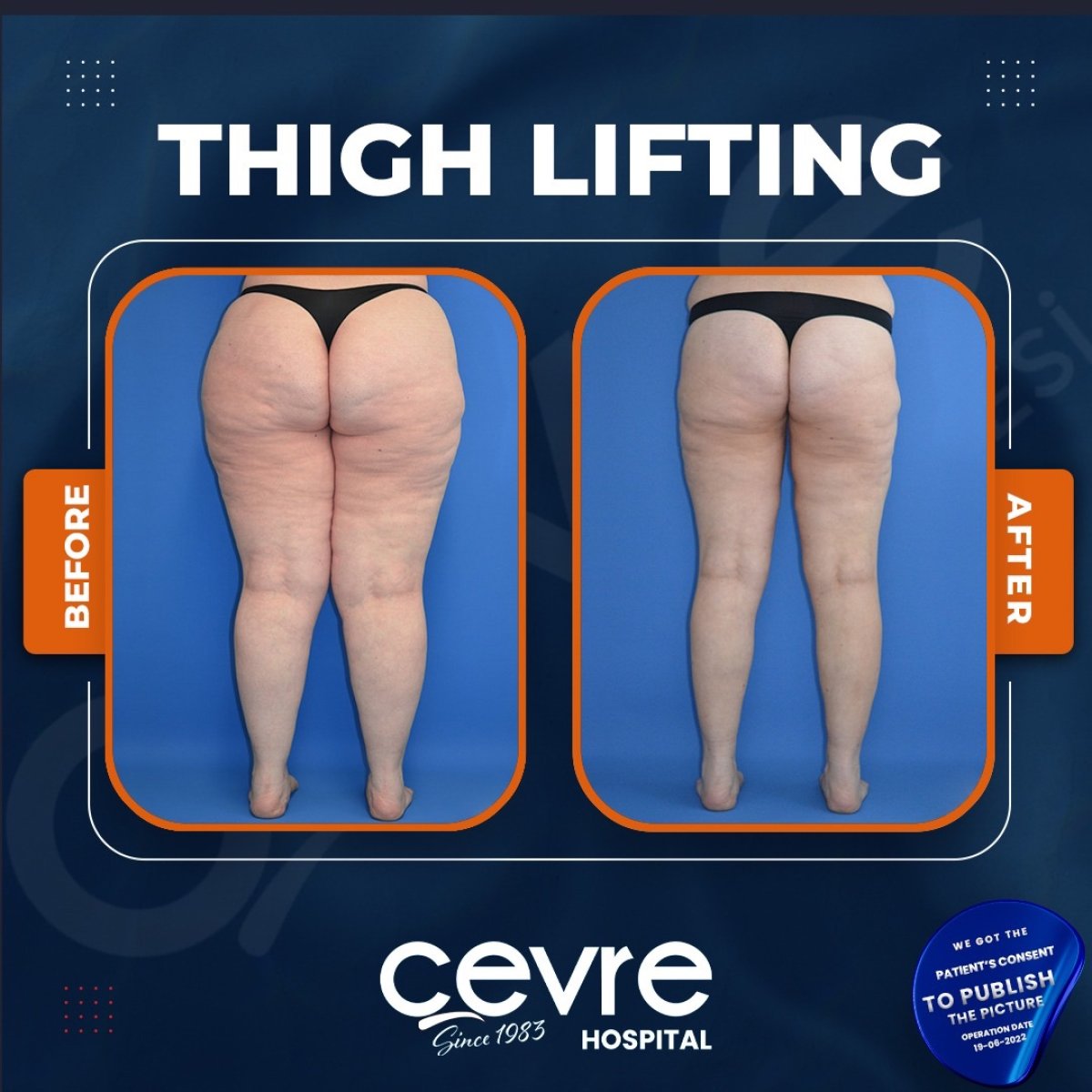 Resultados de lifting de muslos antes y después en Adem and Havva Medical Center, mejor contorno