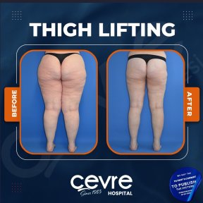 Resultados de lifting de muslos antes y después en Adem and Havva Medical Center, mejor contorno