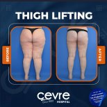 Resultados de lifting de muslos antes y después en Adem and Havva Medical Center, mejor contorno