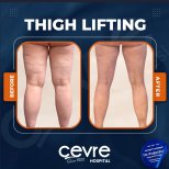 Resultados de lifting de muslos antes y después en Adem and Havva Medical Center, mejor contorno