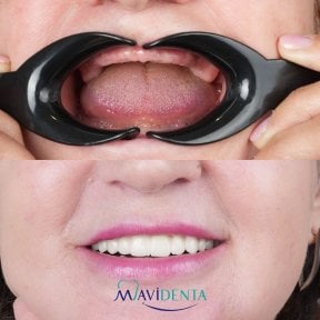 before-after photo all-on-4-dental-implants