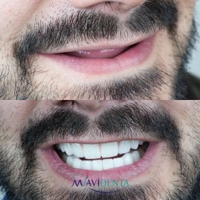 before-after photo all-on-4-dental-implants