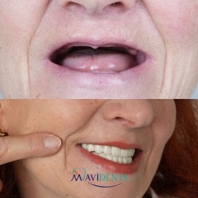 before-after photo all-on-4-dental-implants