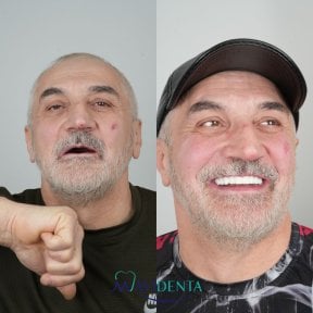 before-after photo all-on-4-dental-implants