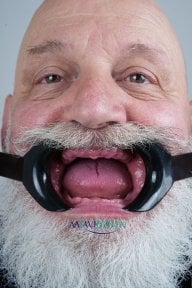 before-after photo all-on-4-dental-implants