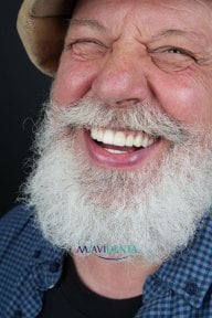 before-after photo all-on-4-dental-implants