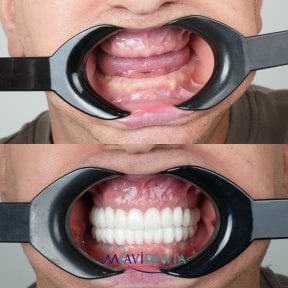 before-after photo all-on-4-dental-implants