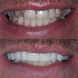 Before and after All-on-4 dental implants result at Dentica by Cristina Suaza, smile restoration