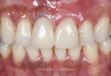 before-after photo all-on-4-dental-implants