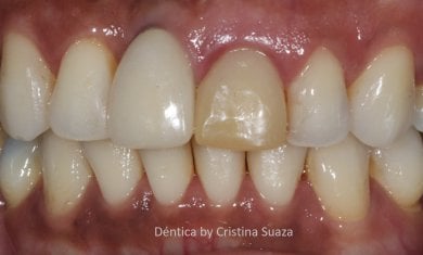 before-after photo all-on-4-dental-implants
