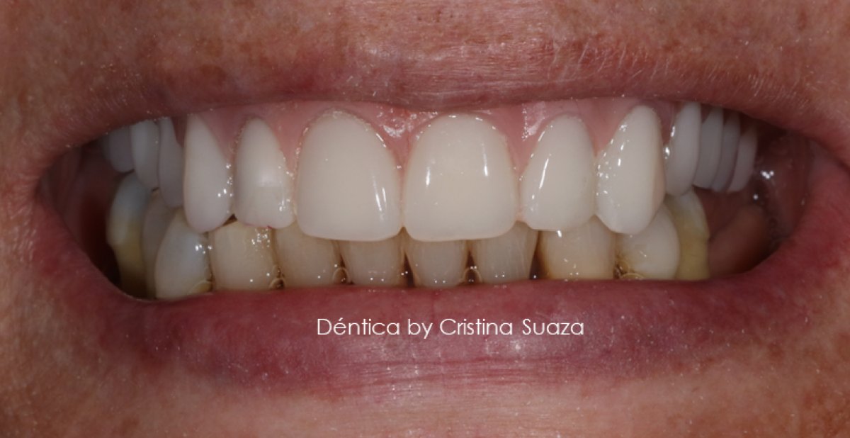 Resultado de implantes dentales All-on-4 de zirconia en Dentica by Cristina Suaza, dientes superiores