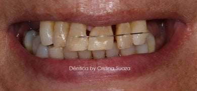 before-after photo zirconia-all-on-4-dental-implants