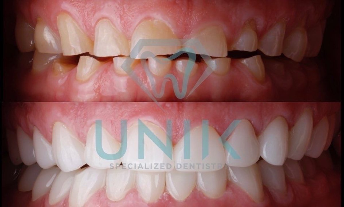 قبل وبعد تركيب تيجان الزركونيا في Unik Specialized Dentistry، نتيجة تجميل الابتسامة