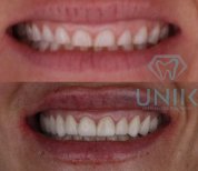 Before and after zirconia crown installation at Unik Specialized Dentistry, smile makeover result