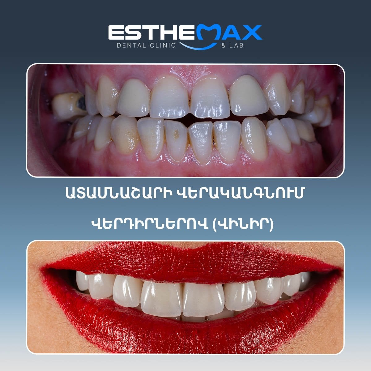 Resultado de carillas dentales antes y después en Esthemax Dental Clinic – sonrisa transformada