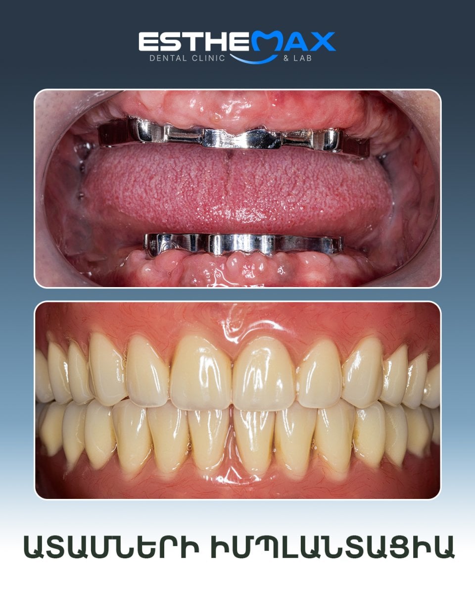 نتائج زراعة الأسنان قبل وبعد في عيادة Esthemax – ترميم كامل للفم