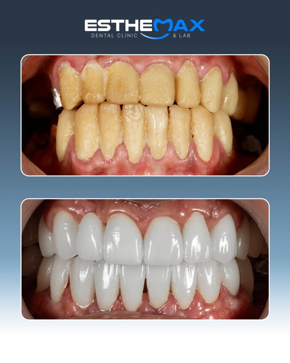نتائج زراعة الأسنان قبل وبعد في عيادة Esthemax – ابتسامة بيضاء مستعادة