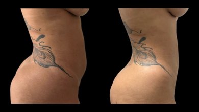 before-after photo liposuction