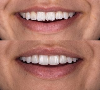 Before and after smile makeover results at Dental Bliss – improved teeth alignment and color