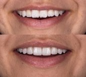 Before and after smile makeover results at Dental Bliss – improved teeth alignment and color