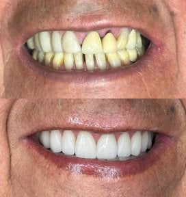 Before and after smile makeover at Dental Bliss – dental veneers for whiter, even teeth result